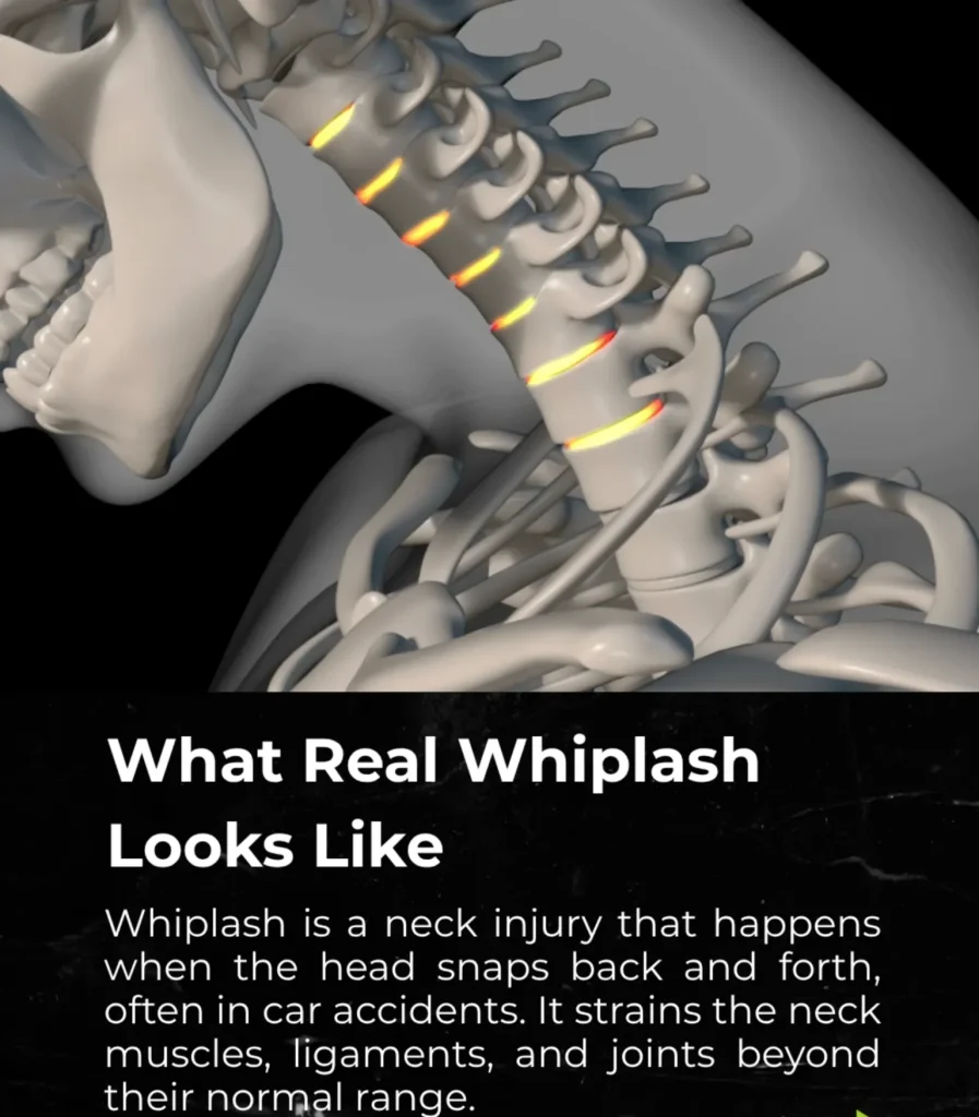 3D illustration of the cervical spine highlighting areas of strain to explain what whiplash looks like after a neck injury.
