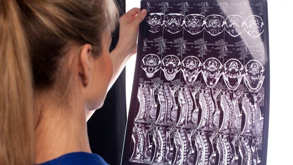 Healthcare provider examining a cervical spine MRI film showing multiple cross-sectional and sagittal views of the neck and upper spine